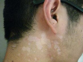 白癜风初期症状有哪些表现 白癜风初期症状有哪些表现